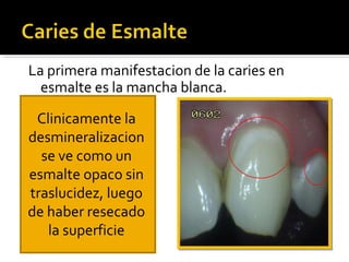 La primera manifestacion de la caries en
esmalte es la mancha blanca.
Clinicamente la
desmineralizacion
se ve como un
esmalte opaco sin
traslucidez, luego
de haber resecado
la superficie

 