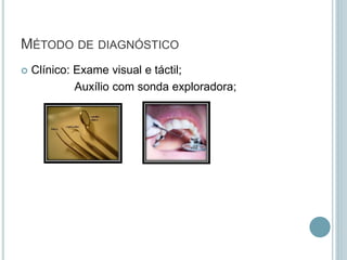 MÉTODO DE DIAGNÓSTICO
 Clínico: Exame visual e táctil;
Auxílio com sonda exploradora;
 