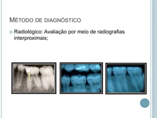  Radiológico: Avaliação por meio de radiografias
interproximais;
MÉTODO DE DIAGNÓSTICO
 