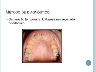 Separação temporária: Utiliza-se um separador
ortodôntico.
MÉTODO DE DIAGNÓSTICO
 
