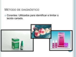  Corantes: Utilizados para identificar e limitar o
tecido cariado.
MÉTODO DE DIAGNÓSTICO
 