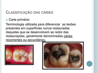 CLASSIFICAÇÃO DAS CÁRIES
 Carie primária:
Terminologia utilizada para diferenciar as lesões
presentes em superfícies nunca restauradas
daquelas que se desenvolvem ao redor das
restaurações, geralmente denominadas cáries
recorrentes ou secundárias.
 