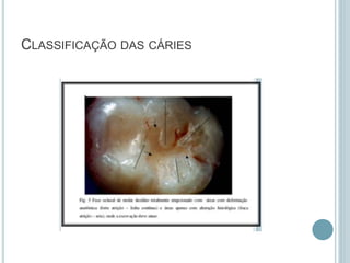 CLASSIFICAÇÃO DAS CÁRIES
 