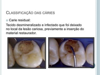  Carie residual:
Tecido desmineralizado e infectado que foi deixado
no local da lesão cariosa, previamente a inserção do
material restaurador.
CLASSIFICAÇÃO DAS CÁRIES
 