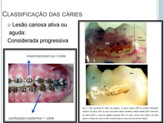  Lesão cariosa ativa ou
aguda:
Considerada progressiva
CLASSIFICAÇÃO DAS CÁRIES
 