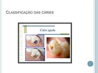 CLASSIFICAÇÃO DAS CÁRIES
 