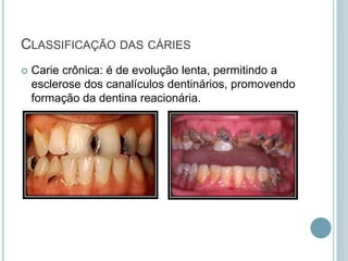  Carie crônica: é de evolução lenta, permitindo a
esclerose dos canalículos dentinários, promovendo
formação da dentina reacionária.
CLASSIFICAÇÃO DAS CÁRIES
 