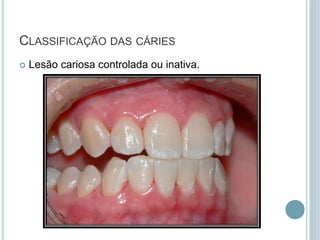  Lesão cariosa controlada ou inativa.
CLASSIFICAÇÃO DAS CÁRIES
 
