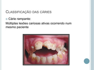  Cárie rampante:
Múltiplas lesões cariosas ativas ocorrendo num
mesmo paciente
CLASSIFICAÇÃO DAS CÁRIES
 