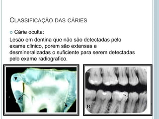  Cárie oculta:
Lesão em dentina que não são detectadas pelo
exame clinico, porem são extensas e
desmineralizadas o suficiente para serem detectadas
pelo exame radiografico.
CLASSIFICAÇÃO DAS CÁRIES
 