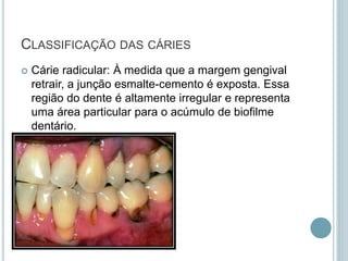  Cárie radicular: À medida que a margem gengival
retrair, a junção esmalte-cemento é exposta. Essa
região do dente é altamente irregular e representa
uma área particular para o acúmulo de biofilme
dentário.
CLASSIFICAÇÃO DAS CÁRIES
 