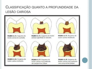 CLASSIFICAÇÃO QUANTO A PROFUNDIDADE DA
LESÃO CARIOSA
 