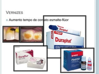 VERNIZES
 Aumento tempo de contato esmalte-flúor
 