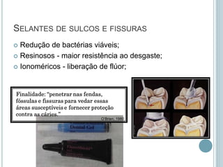 SELANTES DE SULCOS E FISSURAS
 Redução de bactérias viáveis;
 Resinosos - maior resistência ao desgaste;
 Ionoméricos - liberação de flúor;
O’Brien, 1980
 