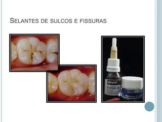SELANTES DE SULCOS E FISSURAS
 