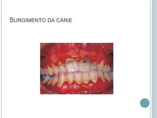 SURGIMENTO DA CÁRIE
 