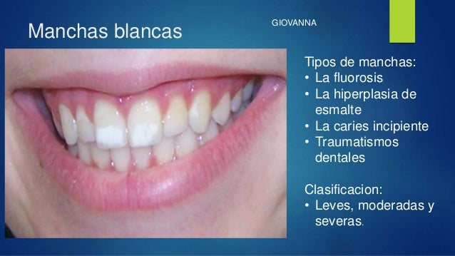 Conceptos actuales de la etiología de las caries