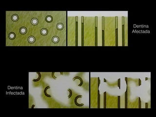 Dentina
Afectada
Dentina
Infectada
 