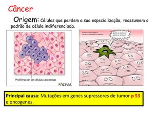 Câncer
Origem: Células que perdem a sua especialização, reassumem o
padrão de célula indiferenciada.
Principal causa: Mutações em genes supressores de tumor p 53
e oncogenes.
 
