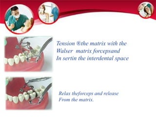 Tension ®the matrix with the 
Walser matrix forcepsand 
In sertin the interdental space 
Relax theforceps and release 
From the matrix. 
 