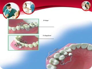 O-shape 
X-shapefront 
 