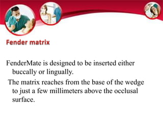 FenderMate is designed to be inserted either 
buccally or lingually. 
The matrix reaches from the base of the wedge 
to just a few millimeters above the occlusal 
surface. 
 