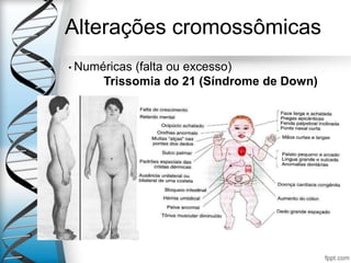 Alterações cromossômicas
• Numéricas (falta ou excesso)
Trissomia do 21 (Síndrome de Down)
 