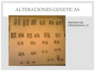 ALTERACIONES GENETICAS
TRISOMIA DEL
CROMOSOMA 21

 