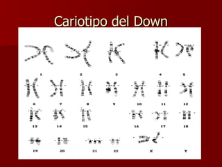 Cariotipo del Down
 