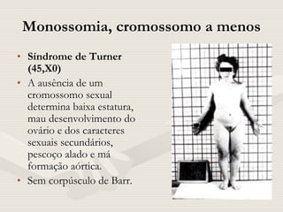 Monossomia, cromossomo a menos
• Síndrome de Turner
(45,X0)
• A ausência de um
cromossomo sexual
determina baixa estatura,
mau desenvolvimento do
ovário e dos caracteres
sexuais secundários,
pescoço alado e má
formação aórtica.
• Sem corpúsculo de Barr.
 