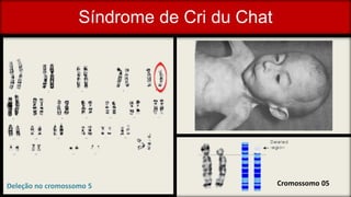 Síndrome de Cri du Chat
Deleção no cromossomo 5 Cromossomo 05
 