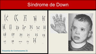 Síndrome de Down
Trissomia do Cromossomo 21
 