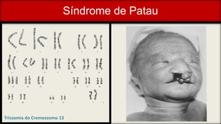 Síndrome de Patau
Trissomia do Cromossomo 13
 