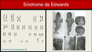Síndrome de Edwards
Trissomia do Cromossomo 18
 