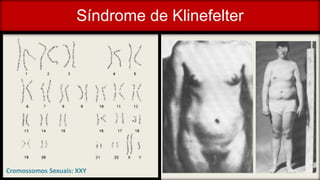 Síndrome de Klinefelter
Cromossomos Sexuais: XXY
 