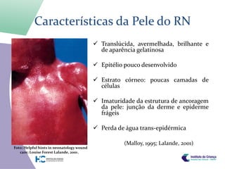 Características da Pele do RN
                                            Translúcida, avermelhada, brilhante e
                                             de aparência gelatinosa

                                            Epitélio pouco desenvolvido

                                            Estrato córneo: poucas camadas de
                                             células

                                            Imaturidade da estrutura de ancoragem
                                             da pele: junção da derme e epiderme
                                             frágeis

                                            Perda de água trans-epidérmica

                                                     (Malloy, 1995; Lalande, 2001)
Foto: Helpful hints in neonatology wound
   care; Louise Forest Lalande, 2001.
 