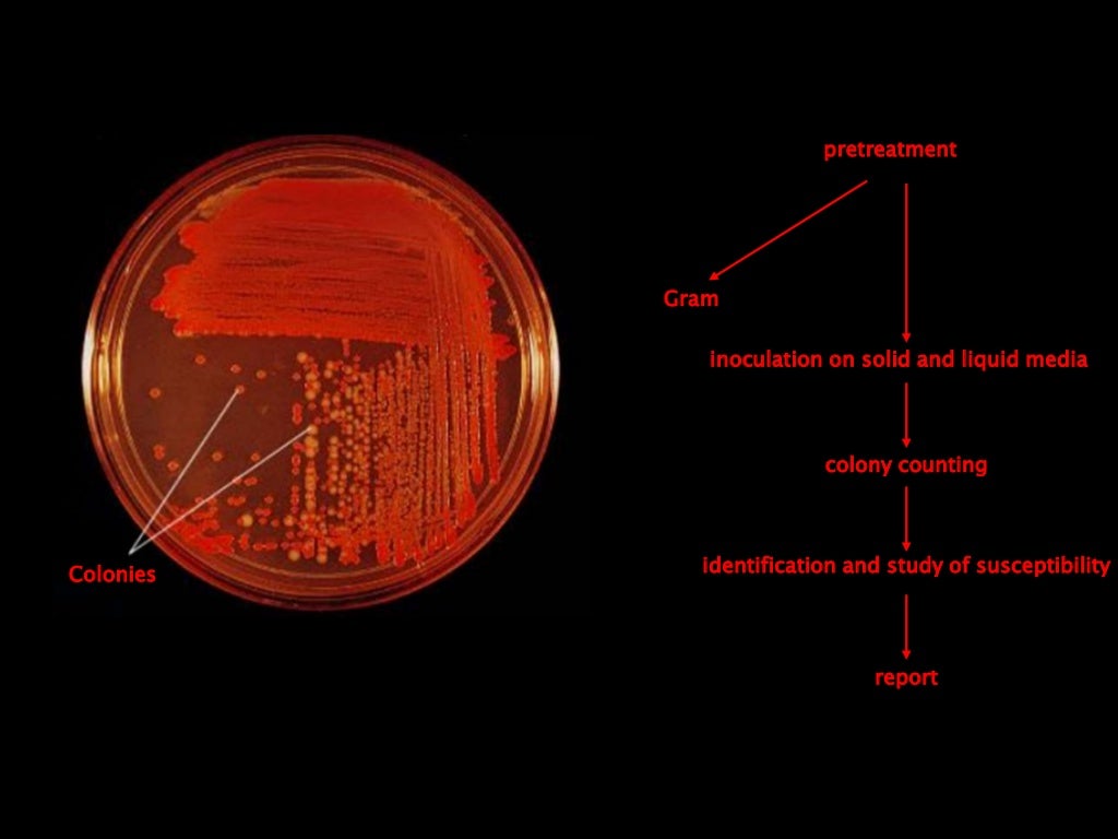 Infected Pressure Ulcers microbiology, staging and clinic