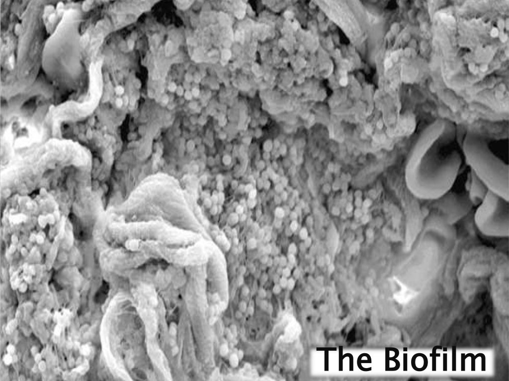 Infected Pressure Ulcers microbiology, staging and clinic
