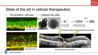 State of the art in cellular therapeutics
• The problem: cell loss replace lost cells
3
Day 45
Whole EB
Multiple delivery sites/layers
Healthy retina
Diseased retina
 