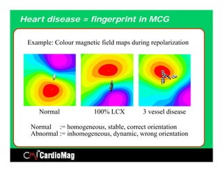 Heart disease = fingerprint in MCG

 Example: Colour magnetic field maps during repolarization




     Normal             100% LCX         3 vessel disease

  Normal := homogeneous, stable, correct orientation
  Abnormal := inhomogeneous, dynamic, wrong orientation
 