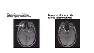 Magnetic Resonance Angiogram
(MRA) image demonstrating an
enlarged superior ophthalmic vein
MA demonstrating a right
carotid cavernous fistula
 