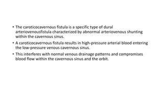 • The caroticocavernous fistula is a specific type of dural
arteriovenousfistula characterized by abnormal arteriovenous shunting
within the cavernous sinus.
• A caroticocavernous fistula results in high-pressure arterial blood entering
the low-pressure venous cavernous sinus.
• This interferes with normal venous drainage patterns and compromises
blood flow within the cavernous sinus and the orbit.
 