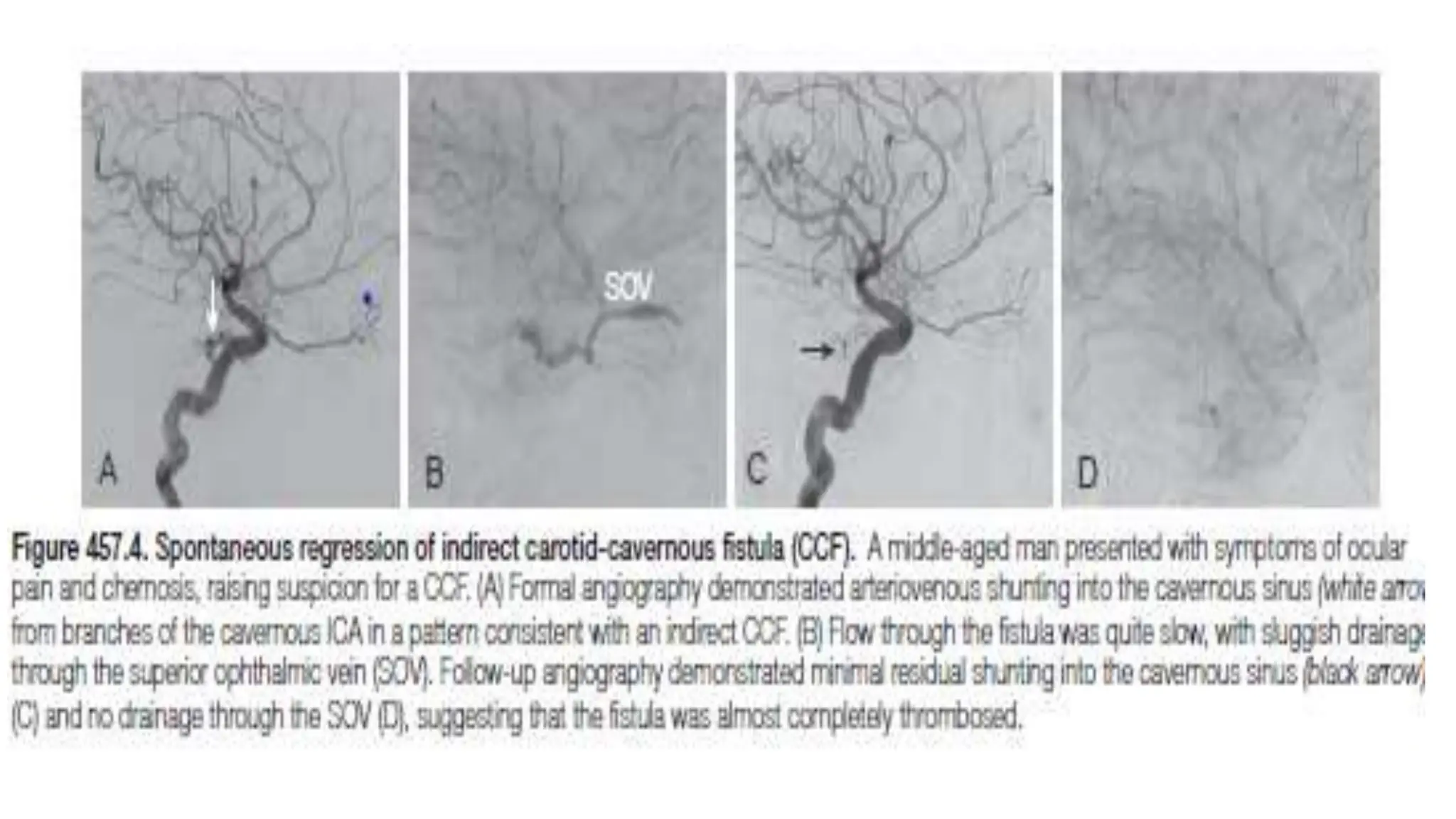 Carotico cavernous fistula and its managment | PPT