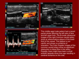 Ultrasound and color Doppler images of the right Common carotid (CCA) and
ICA (internal carotid) arteries show increased p...