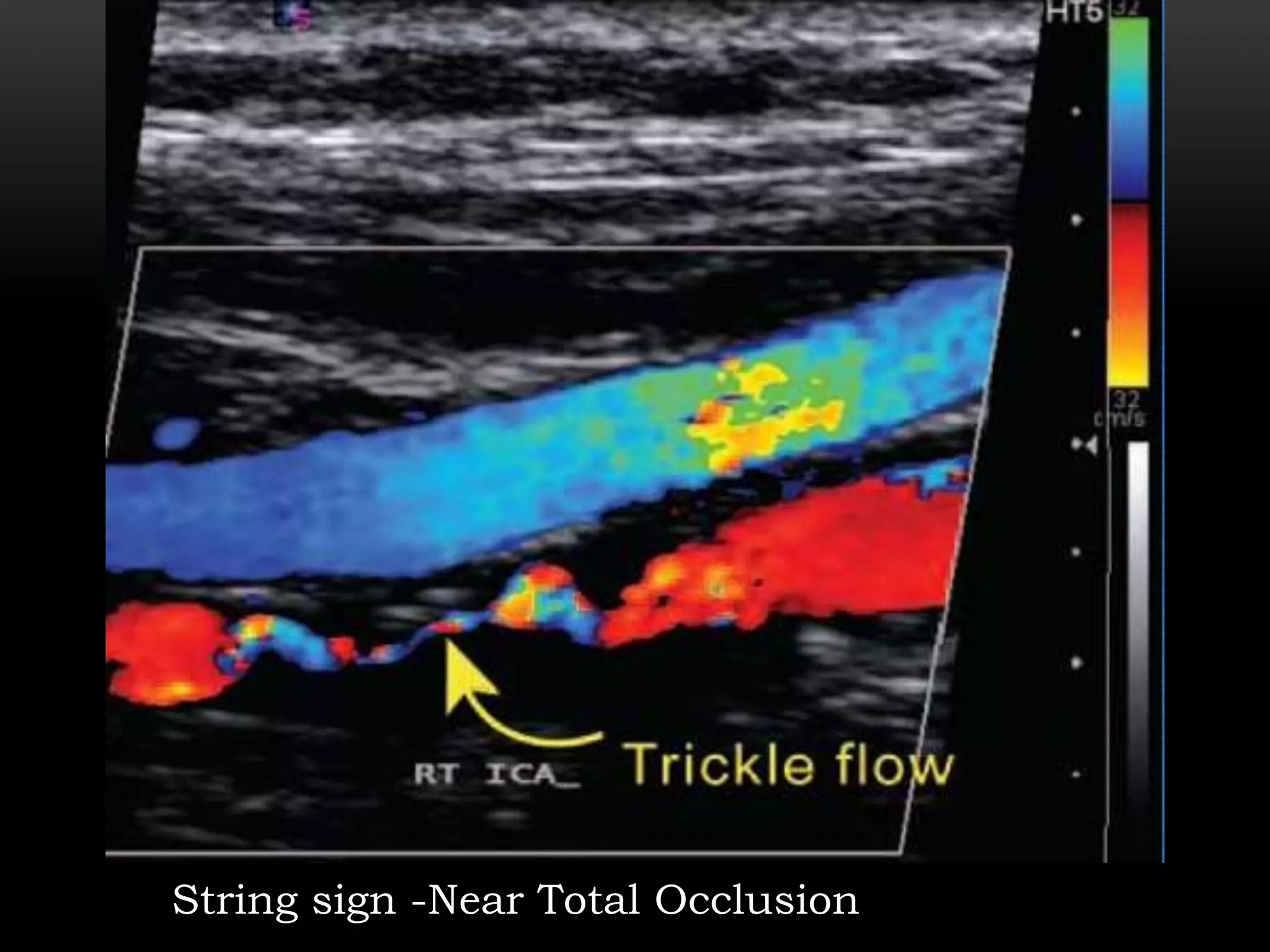 CAROTID DOPPLER STUDY | PPTX