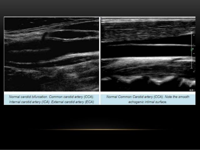 carotid doppler radiology carotid doppler radiology