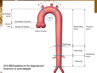 2014 ESCGuidelines on the diagnosisand
treatment of aorticdiseases
 