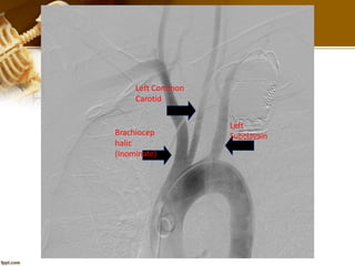 Brachiocep
halic
(Inominate)
Left Common
Carotid
Left
Subclavain
 