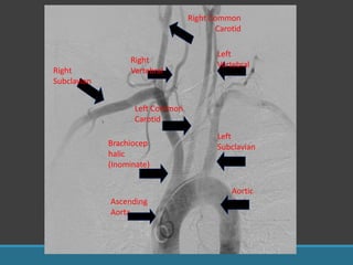Brachiocep
halic
(Inominate)
Left Common
Carotid
Left
Subclavian
Right
Subclavian
Right
Vertebral
Right Common
Carotid
Left
Vertebral
Ascending
Aorta
Aortic
Arch
 