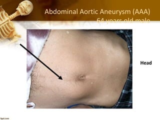 Abdominal Aortic Aneurysm (AAA)
64 years old male
Head
 